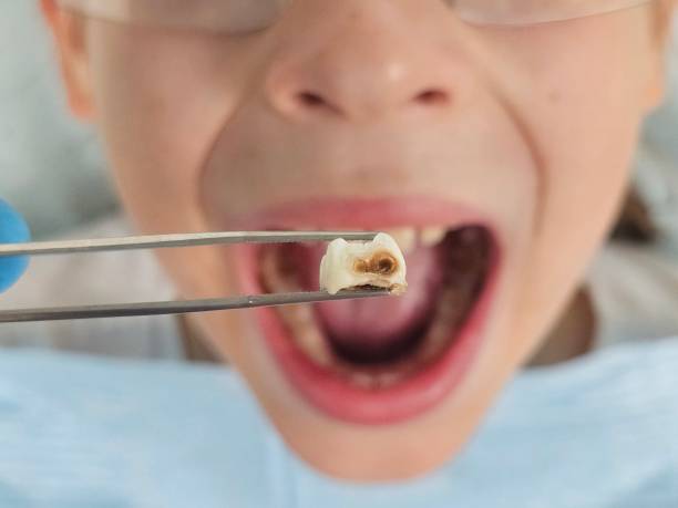 Best Emergency Dental Care for Broken or Chipped Teeth in North Liberty, IA